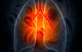 Stage 4 Adenocarcinoma Lung Cancer Treatment in Germany