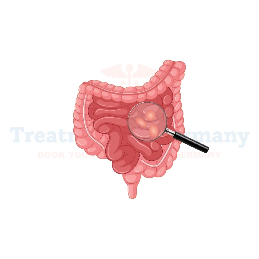Colon Cancer