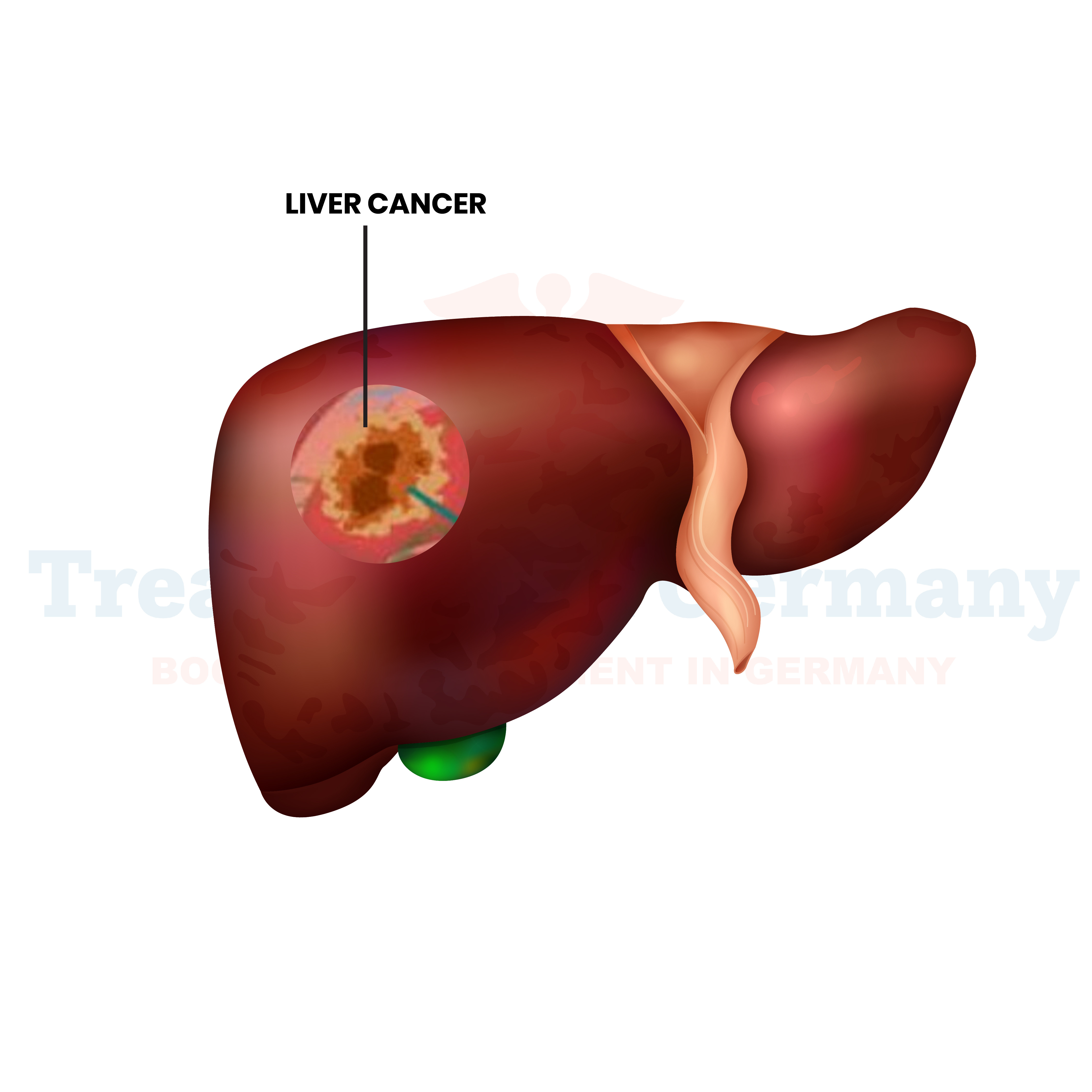 Liver Cancer