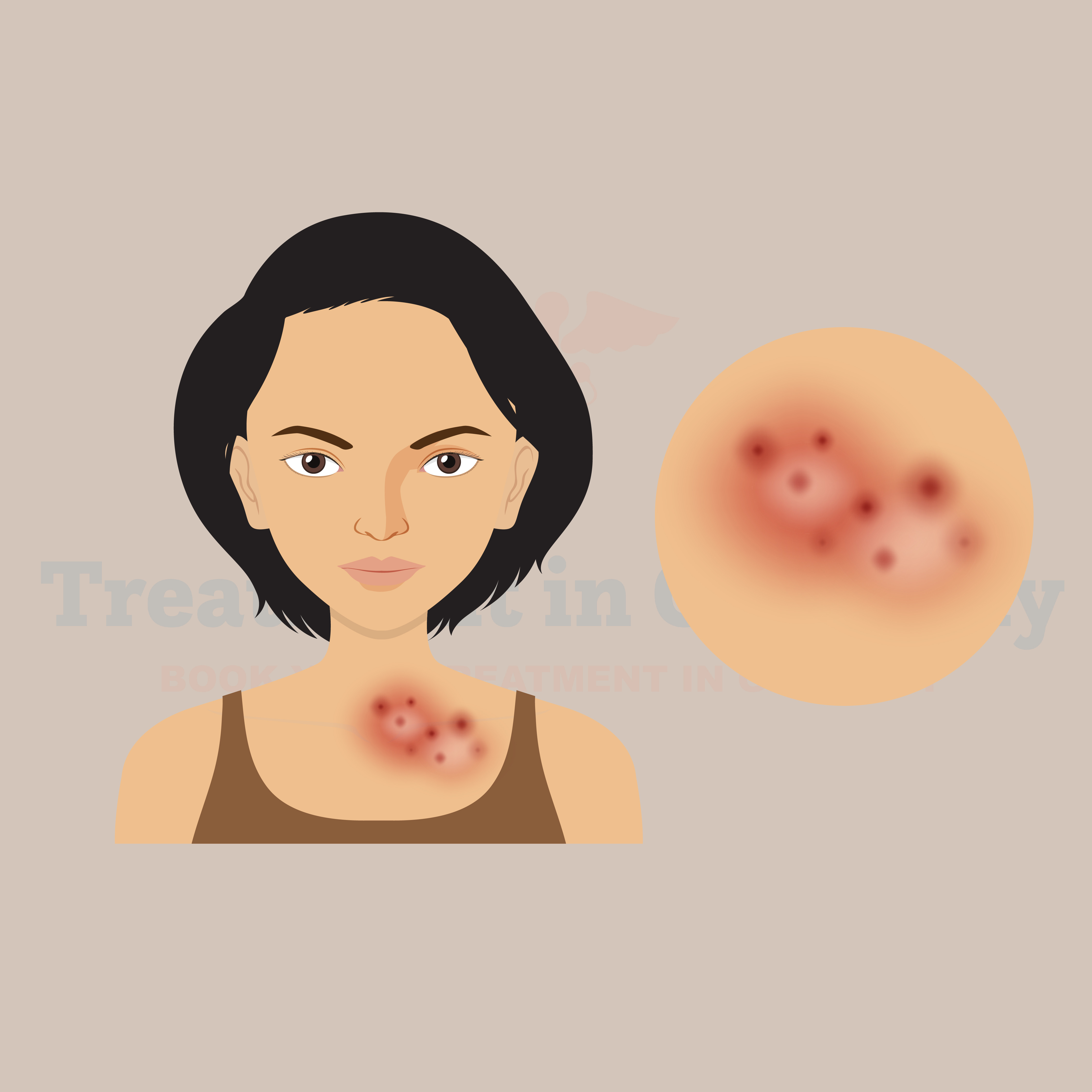 Skin Cancer