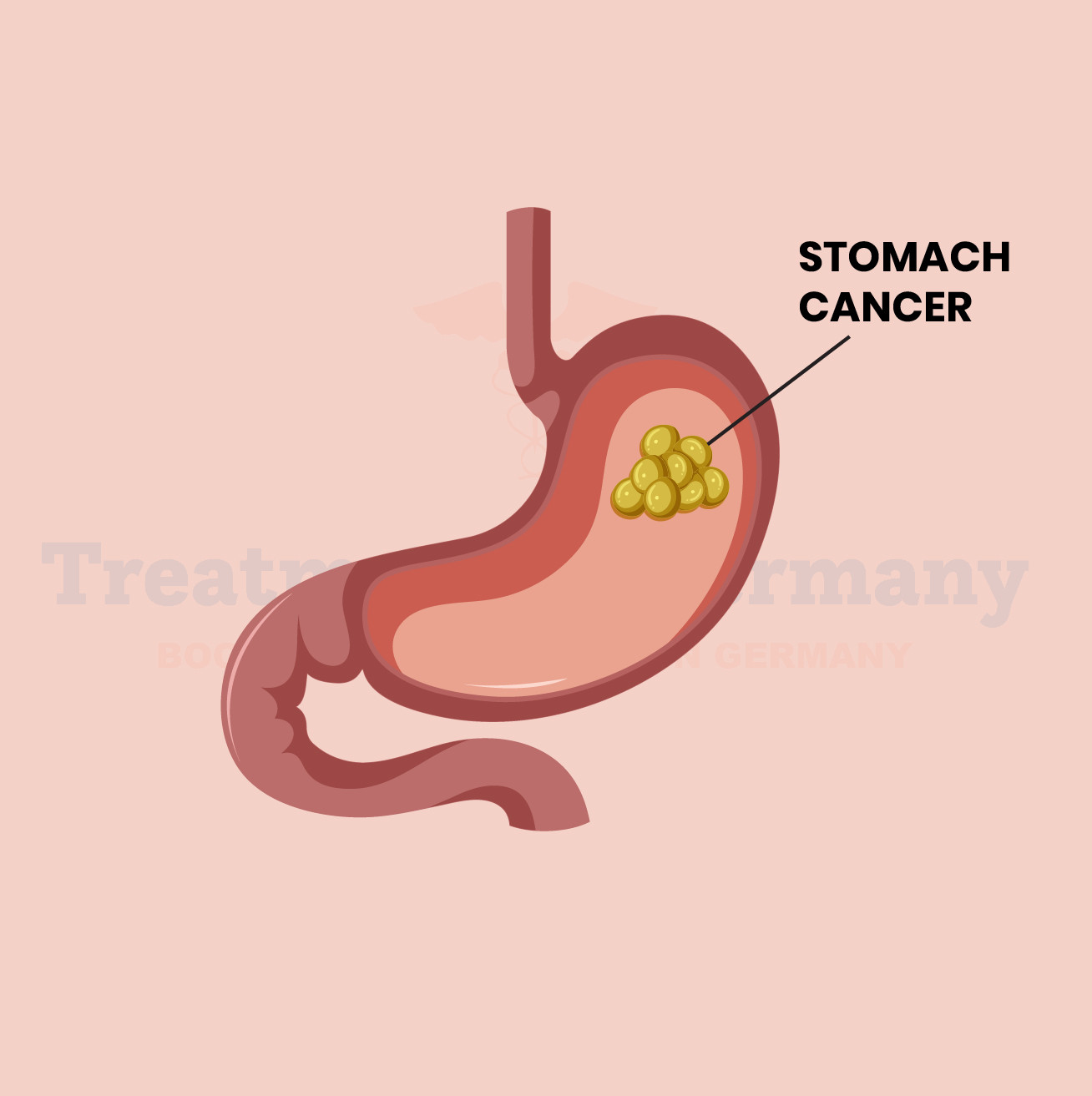 Stomach (Gastric) Cancer