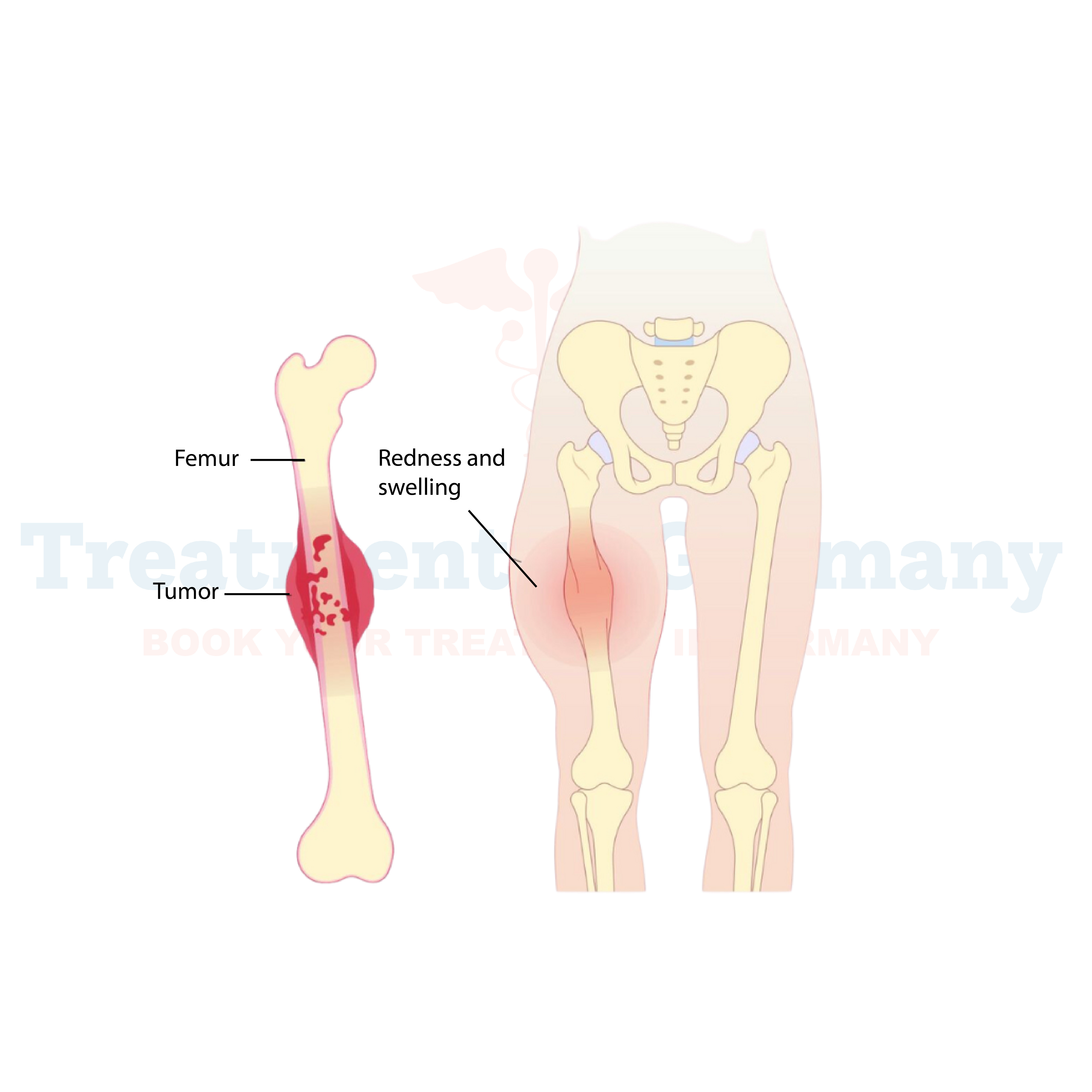 Sarcoma