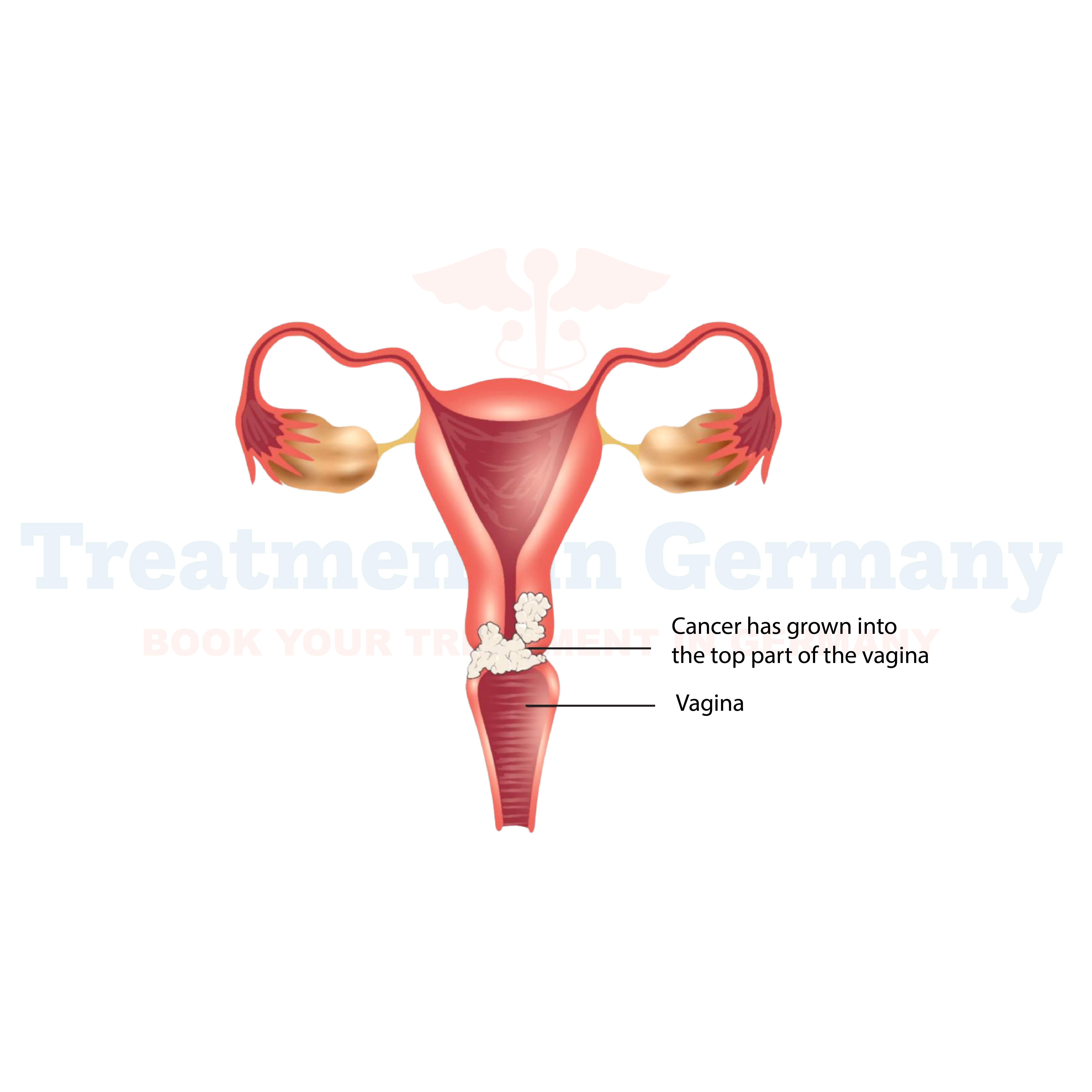 Vaginal Cancer