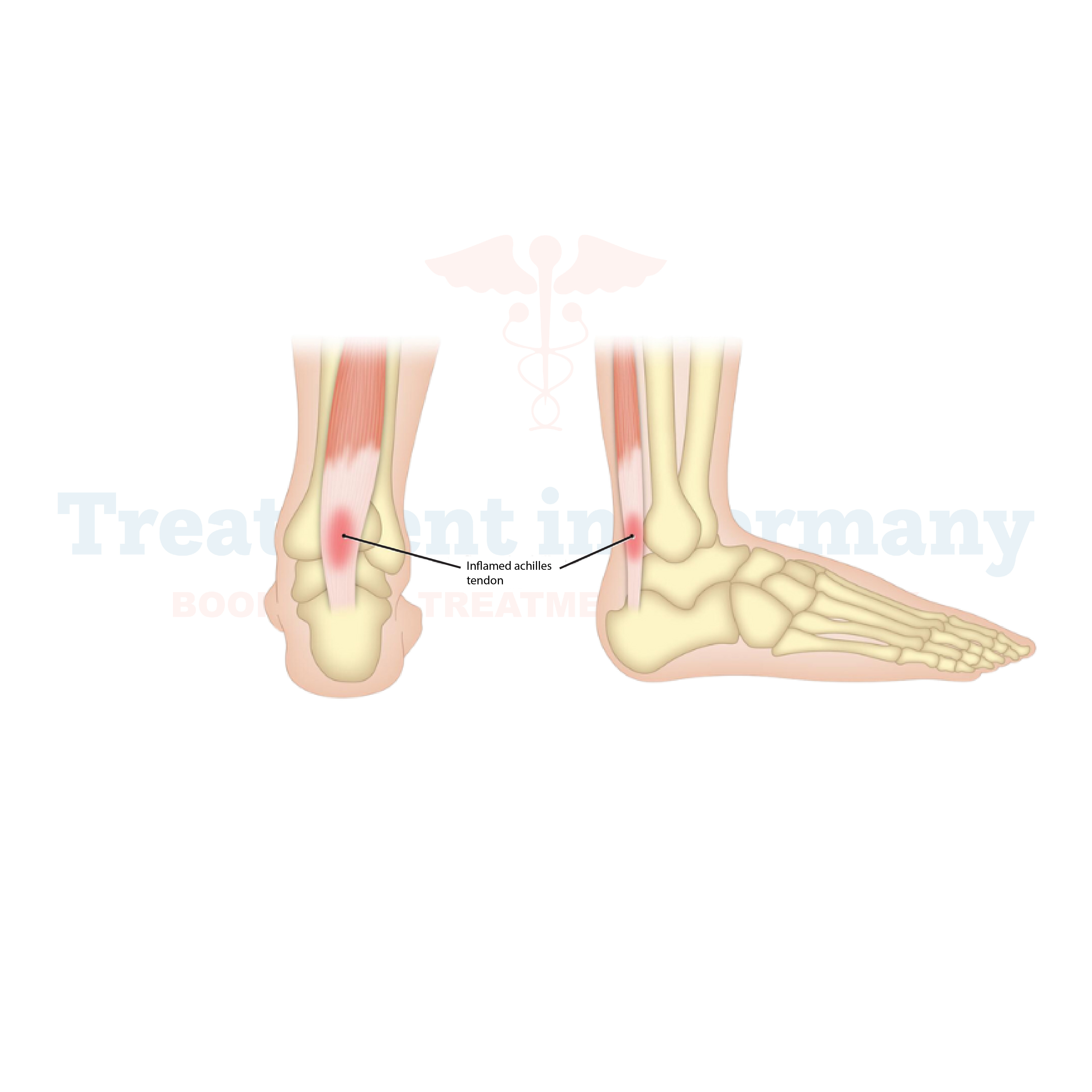 Achilles Tendonitis