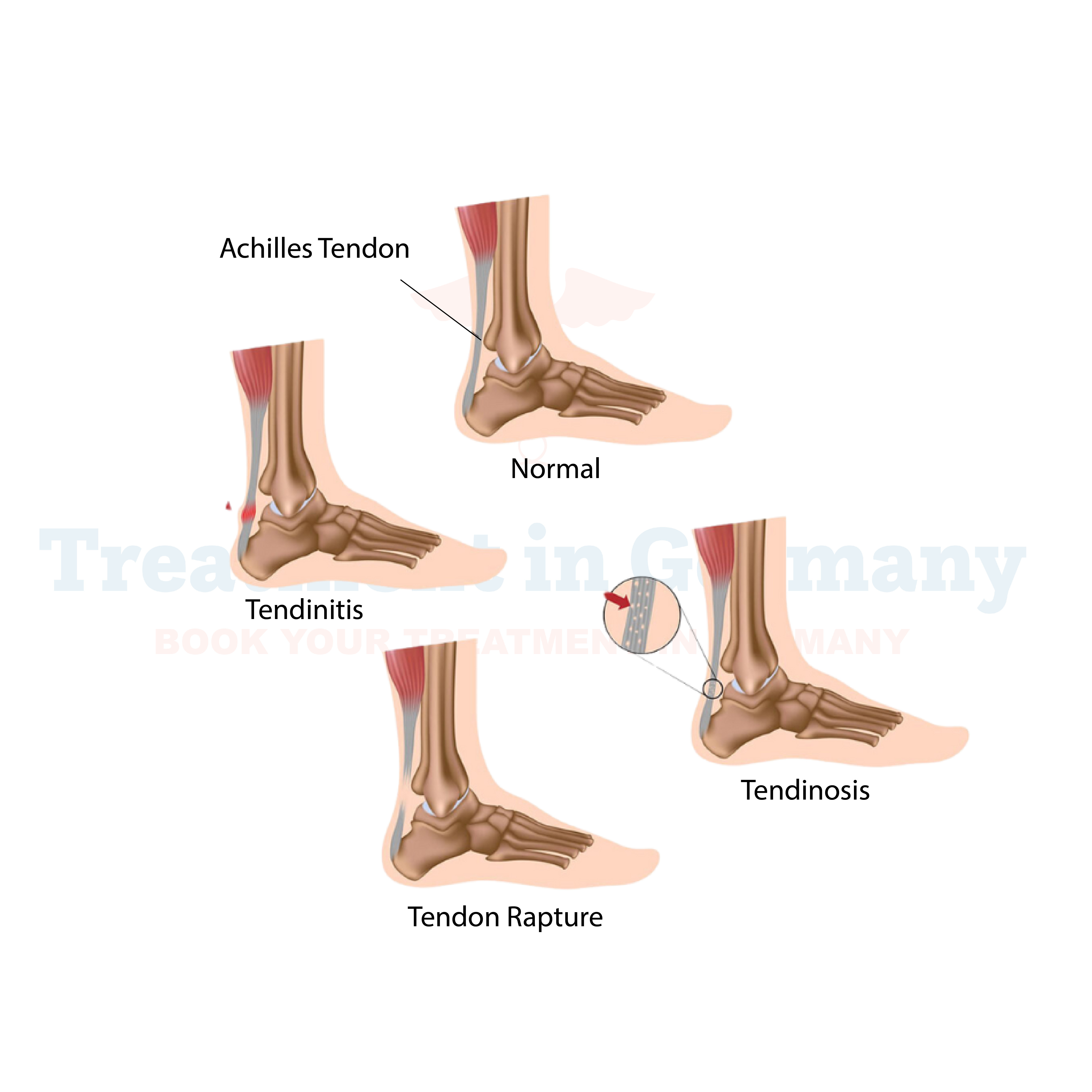 Achilles Tendon Rupture