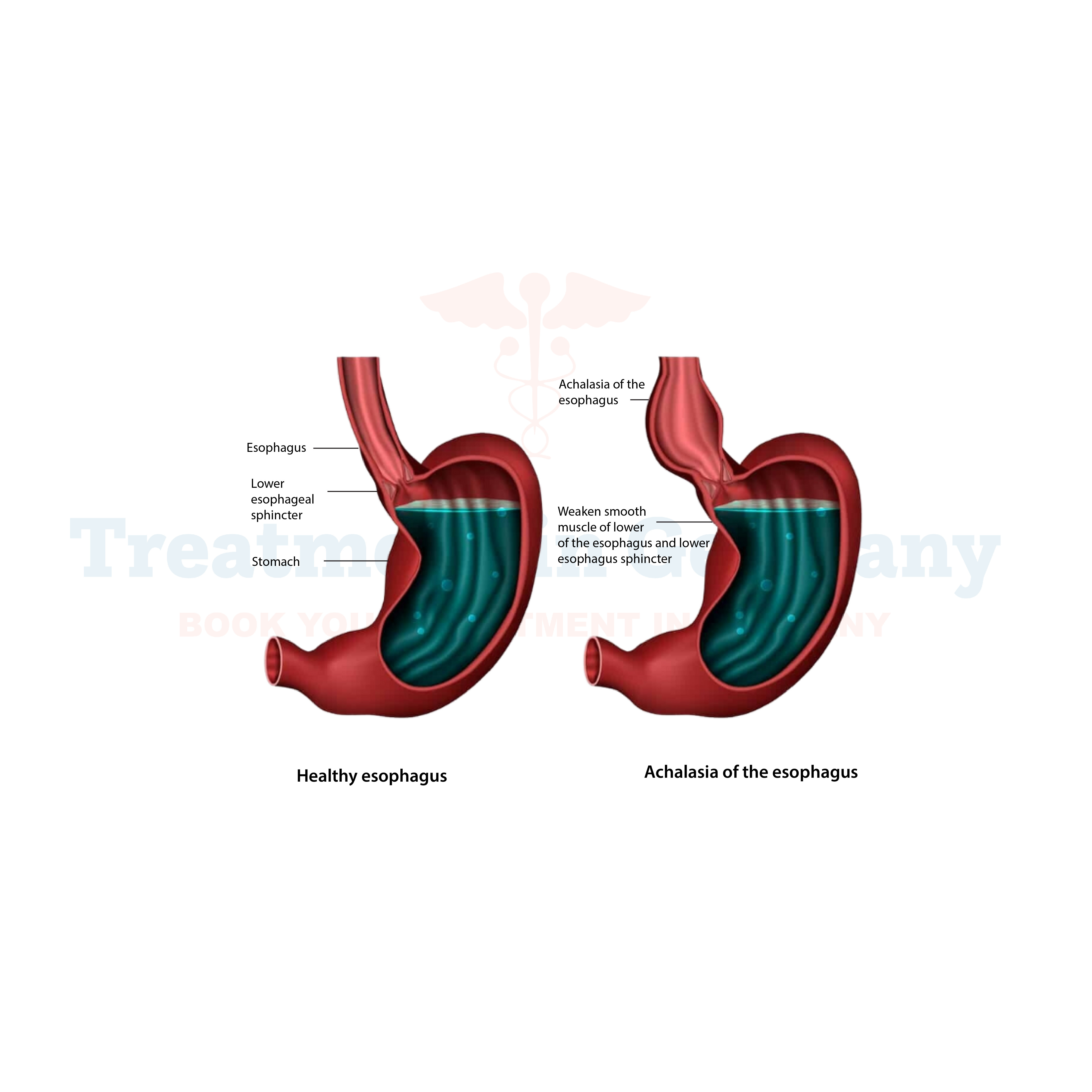 Achalasia