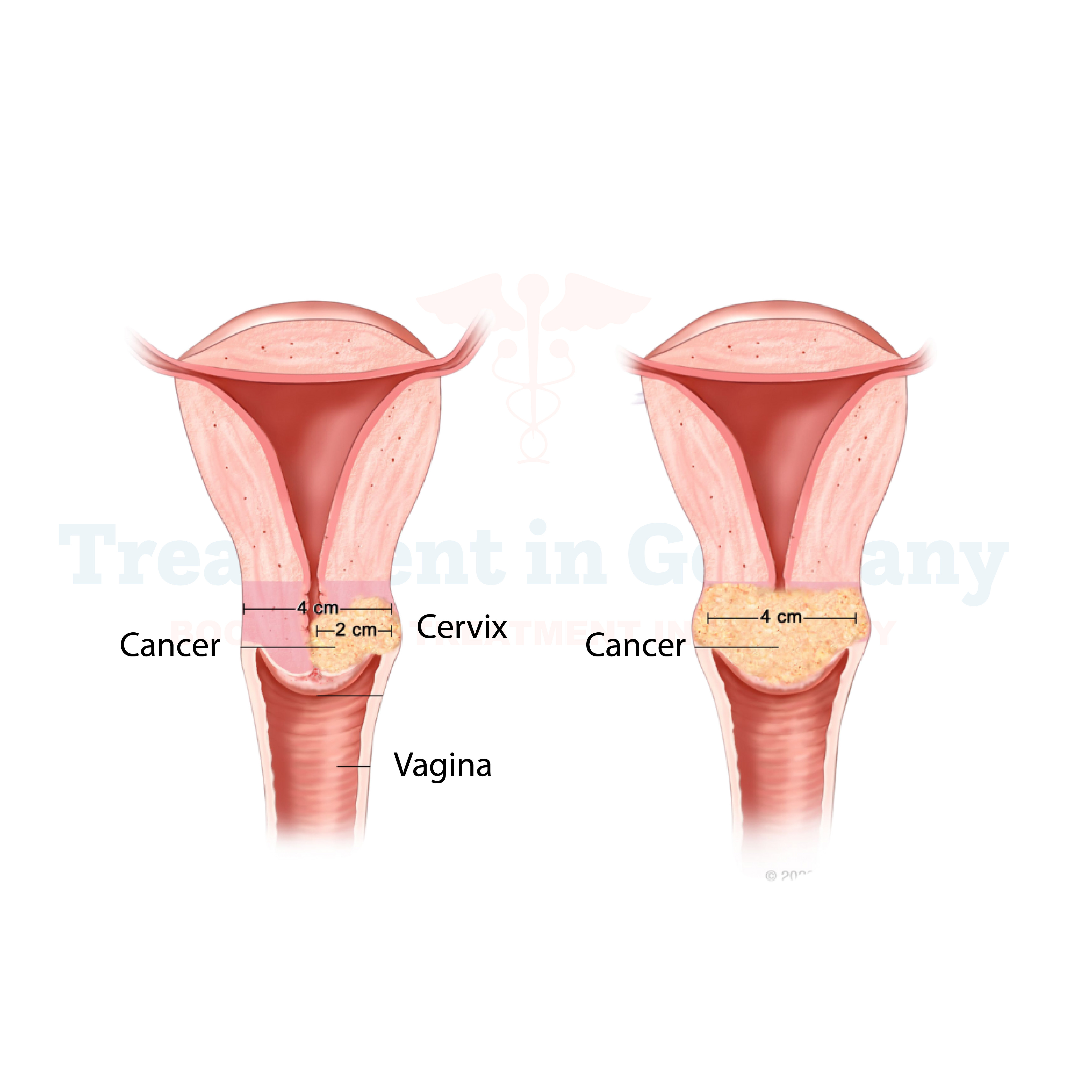 Cervical Cancer