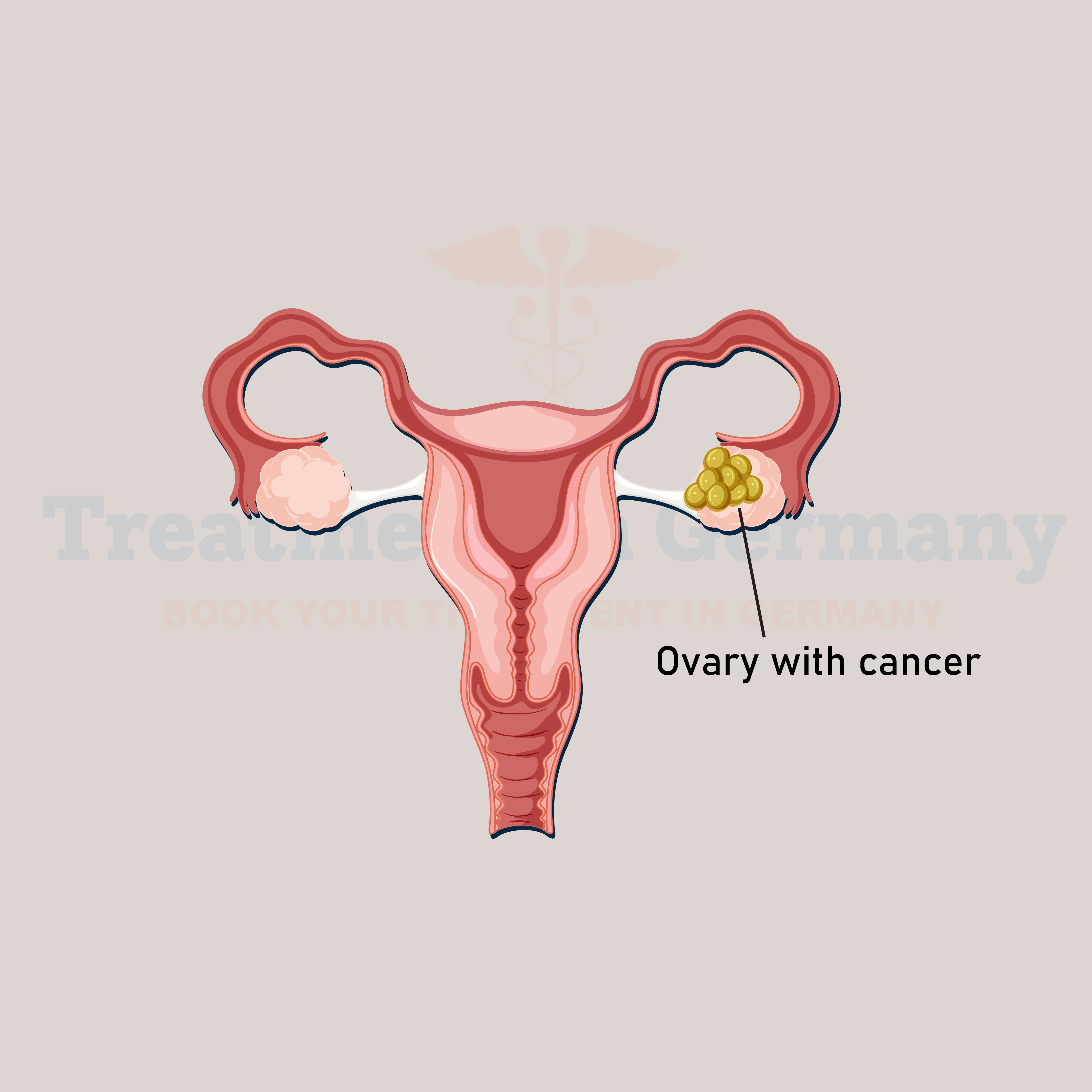 Ovarian Cancer