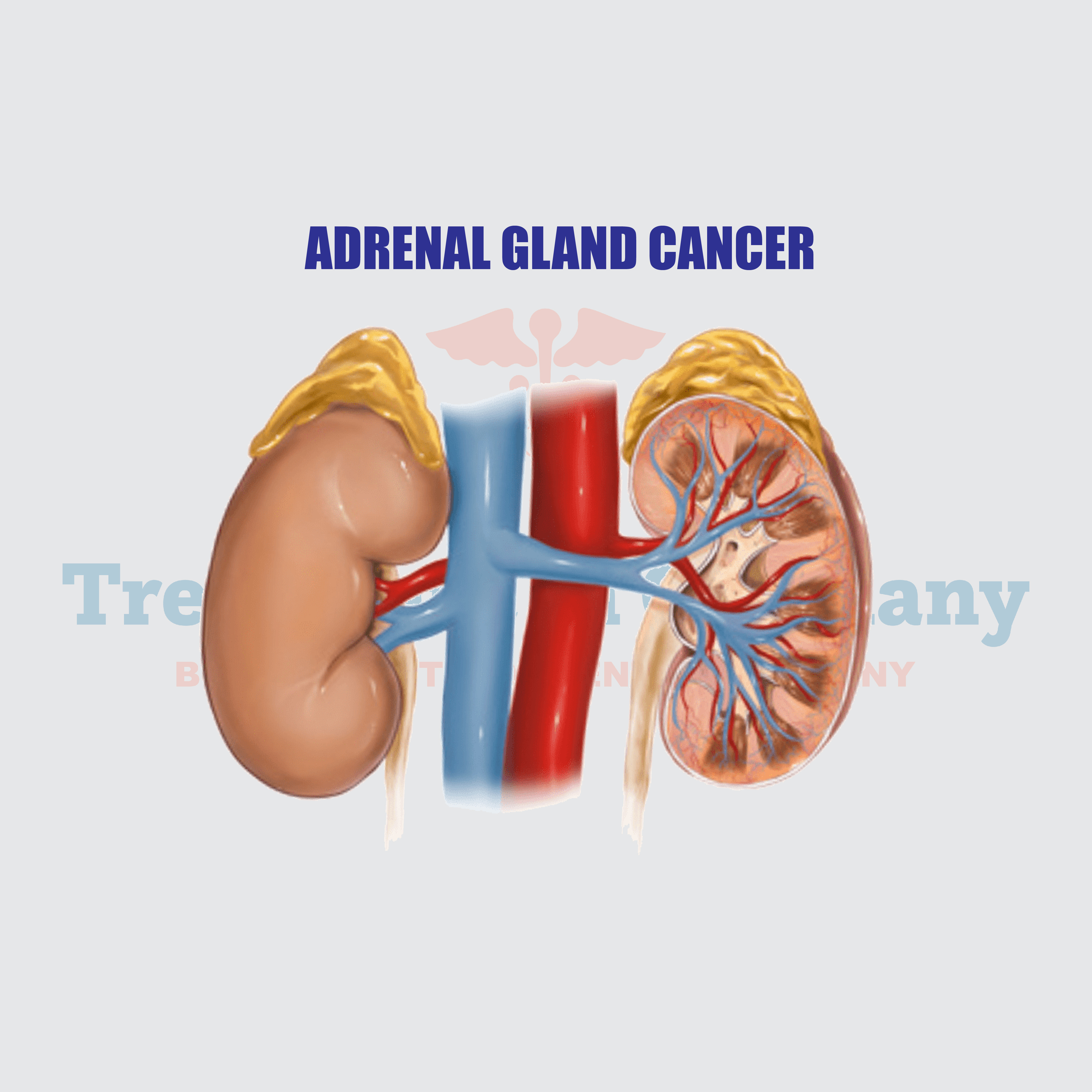 Adrenal Gland Cancer