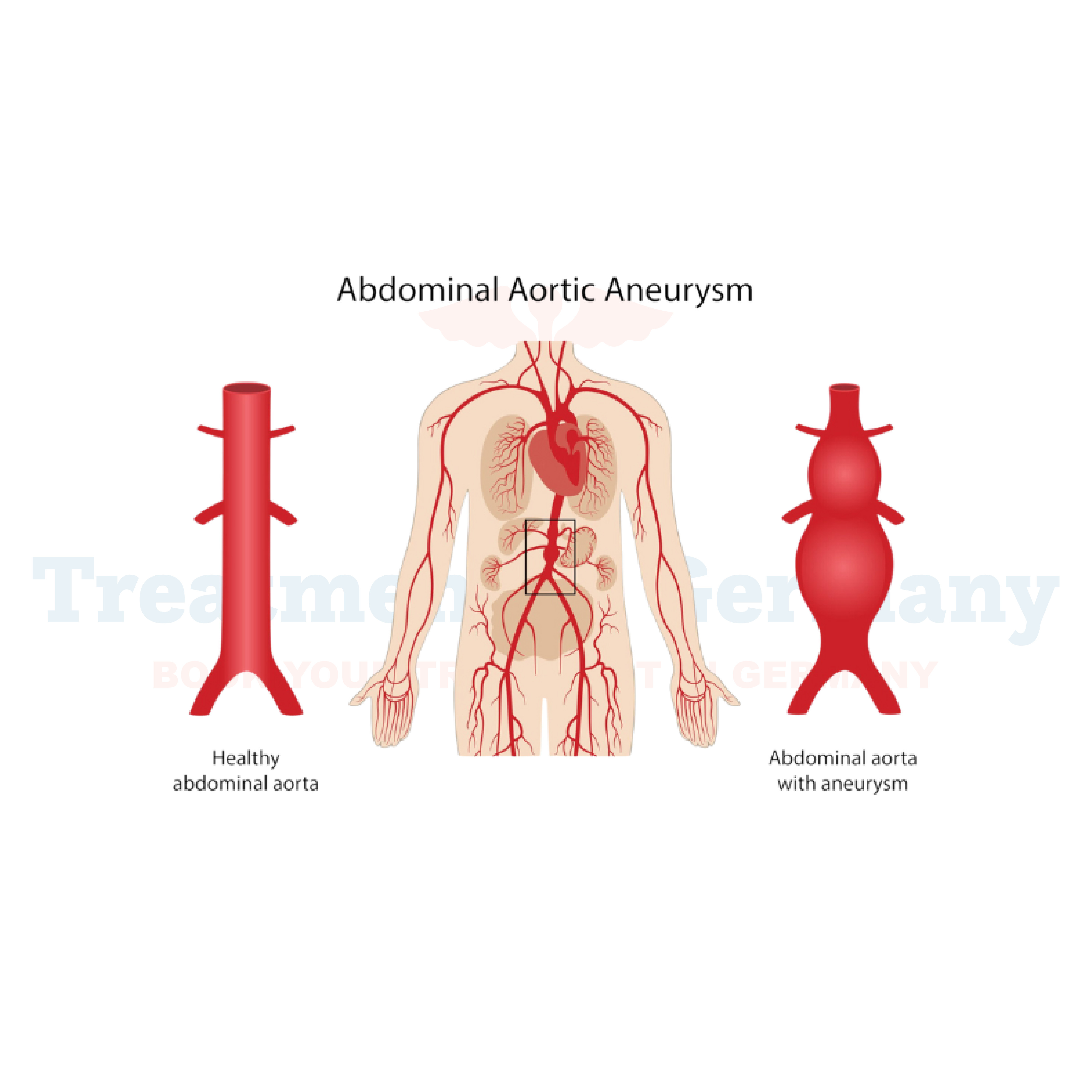 Abdominal Aortic Aneurysm