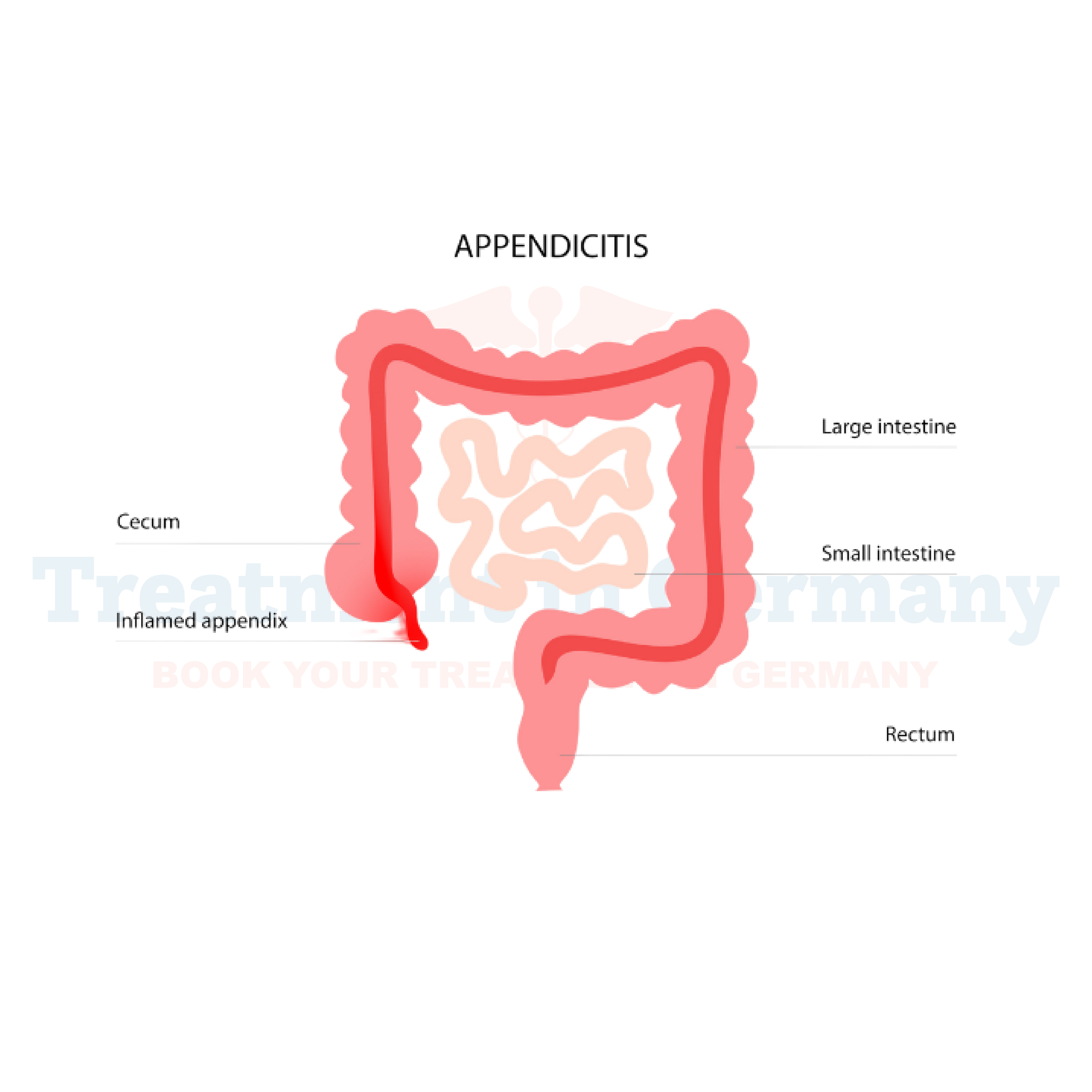 Acute Appendicitis