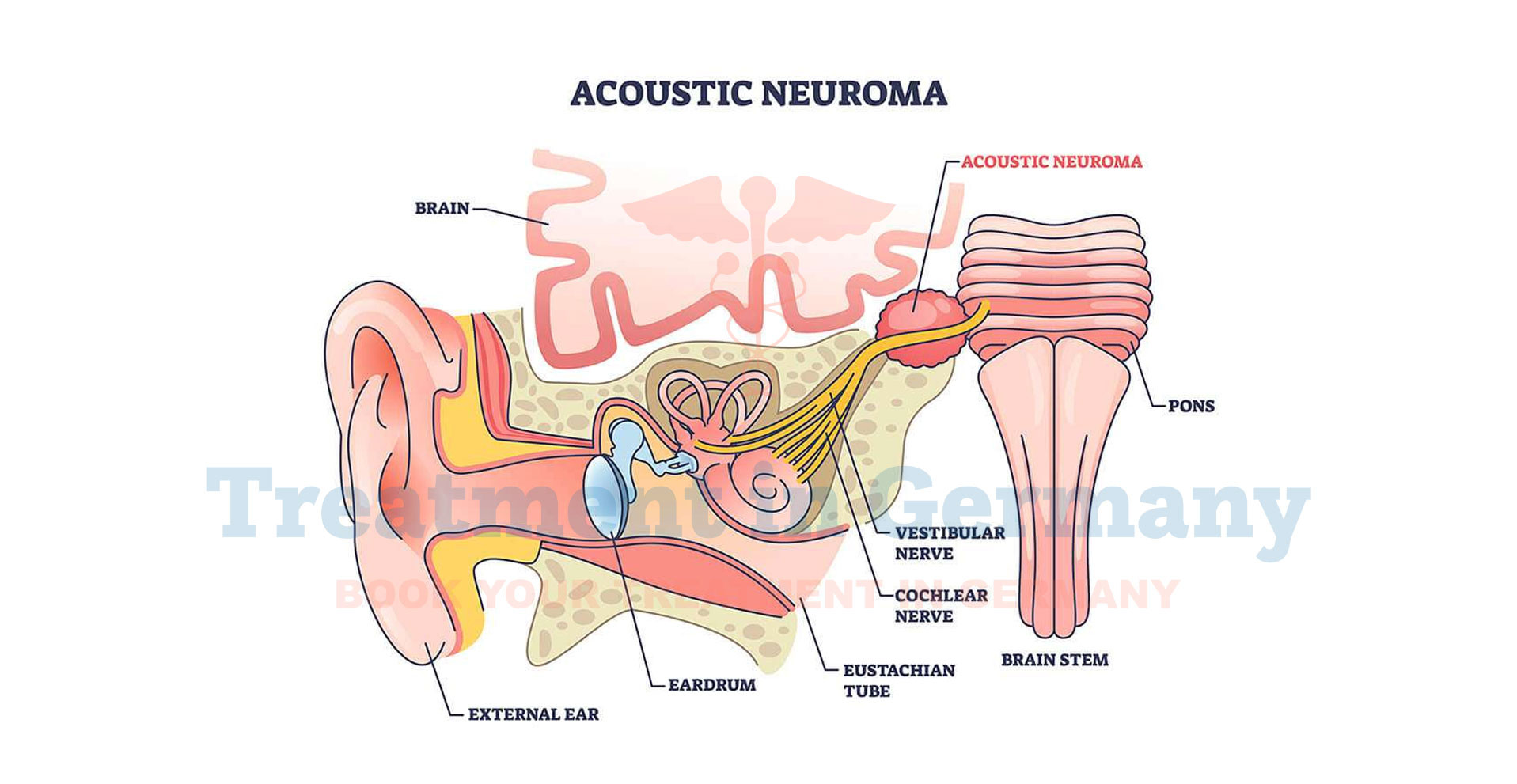 Acoustic Neuroma